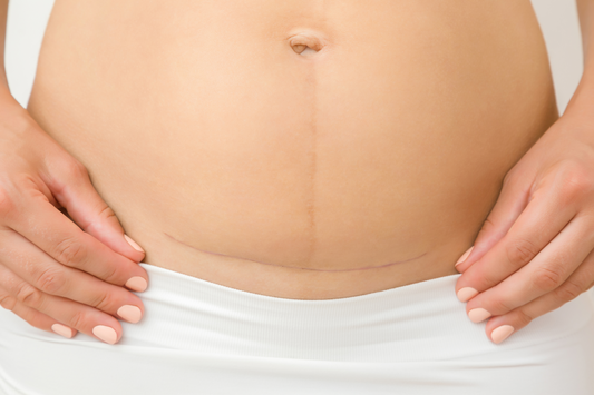 All about C-Section Scars